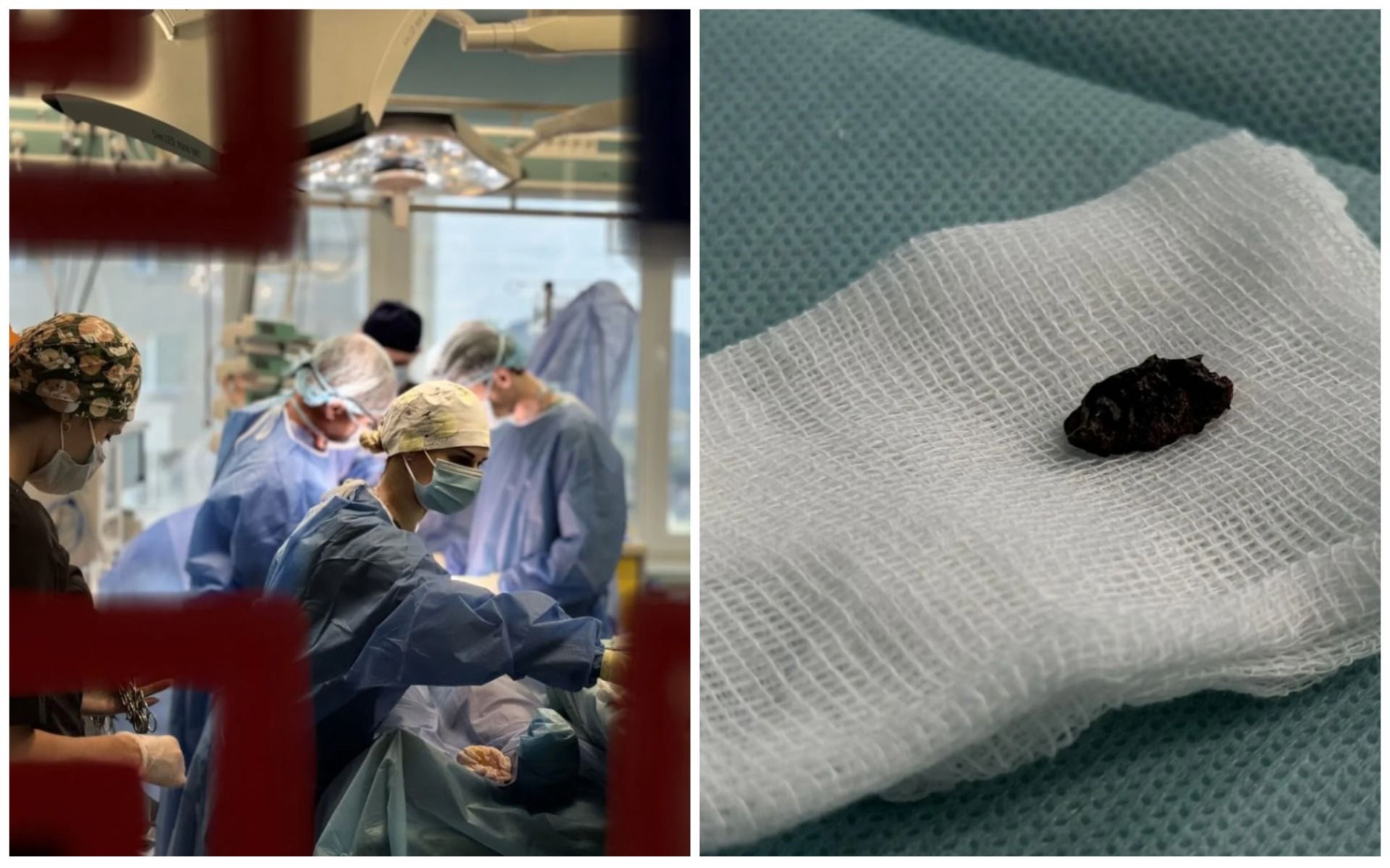 Еще бы миллиметр – и все: как львовские хирурги достали из сердца 22-летней женщины осколок ракеты - Здоровье 24 Еще бы миллиметр – и все: как львовские хирурги достали из сердца 22-летней женщины осколок ракеты - Здоровье 24