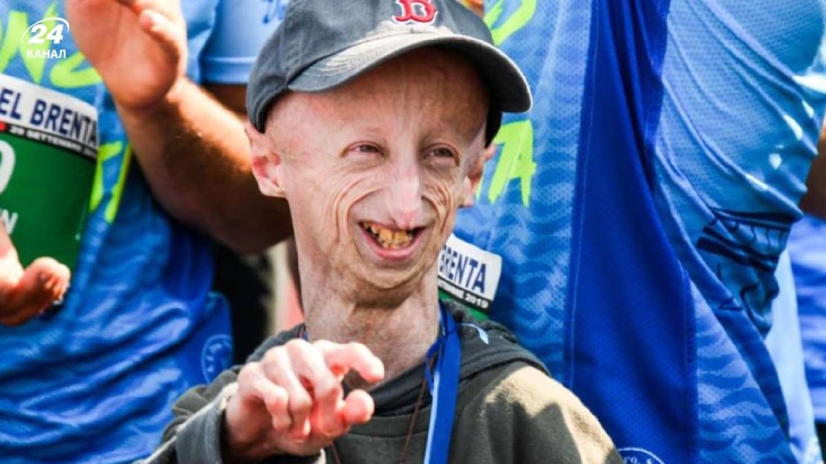 Помер відомий італійський учений із синдромом передчасного старіння  Помер відомий італійський учений із синдромом передчасного старіння