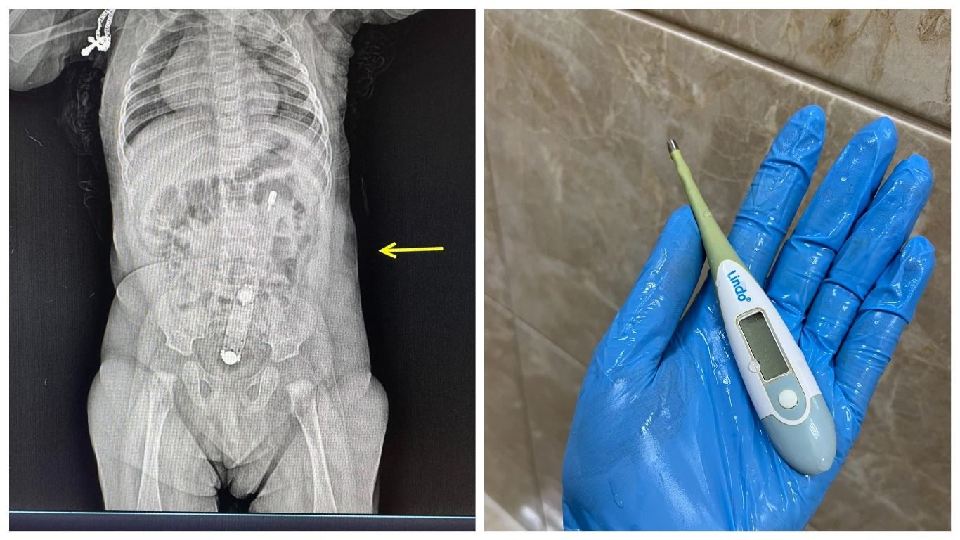 На Волыни медики достали электронный термометр из кишечника младенца - Здоровье 24